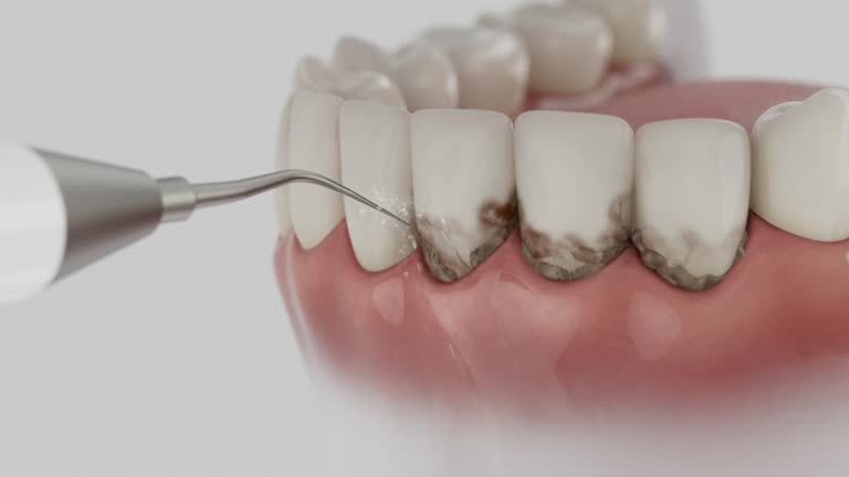 Trusted Wisdom Tooth Removal service in Summersville, WV - Dentist Open Now
